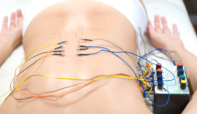 A University of Pennsylvania study found electroacupuncture helps reduce hot flashes in breast cancer survivors. (Photo: San Diego Healing Arts)