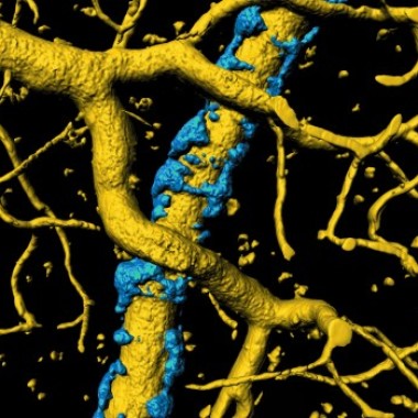 Virginia Tech scientists have uncovered a mechanism in the brain that could account for some of the neural degeneration and memory loss in people with Alzheimer’s disease. A buildup of misfolded proteins causes an exoskeleton (in blue) to form around blood vessels (in gold) in the brain. (Illustration: Virginia Tech)