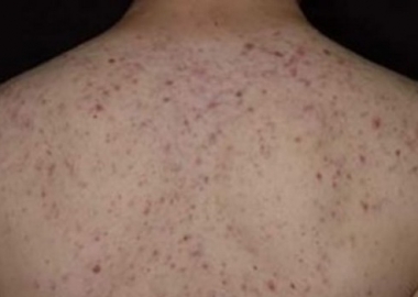 It can be embarassing to wear blouses that show of your back when you have back acne and scars. (Photo: BirthOrderPlus)