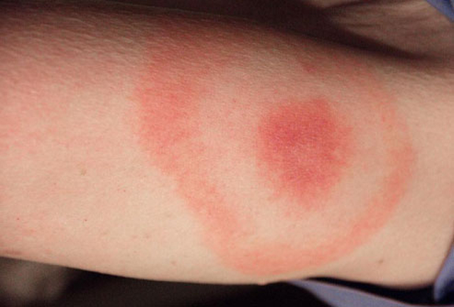 A bulls-eye shaped rash is one symptom of Lyme disease. (Photo: CDC)