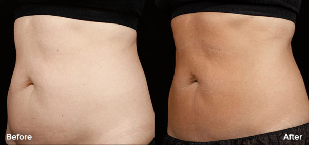 SculpSure melts up to 25 percent of fat in one session. (Photo: DC Derm Docs)