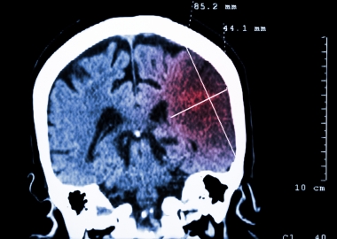A digital scan depicts the brain in blue, with an area on the right side a shade of red, showing the site of a stroke. (Photo: Thinkstock)
