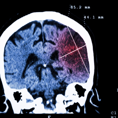 A digital scan depicts the brain in blue, with an area on the right side a shade of red, showing the site of a stroke. (Photo: Thinkstock)