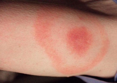 One of the symptoms of Lyme disease is a bull's-eye-like rash where the person was bitten. (Photo: CDC)