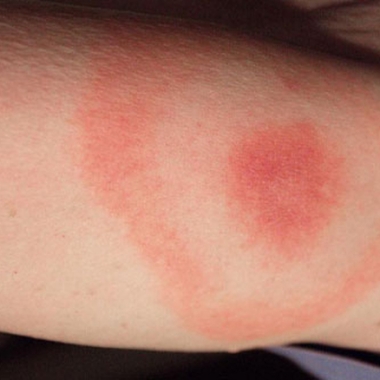 One of the symptoms of Lyme disease is a bull's-eye-like rash where the person was bitten. (Photo: CDC)