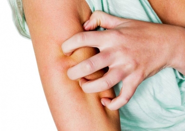 Do not give into scratching your bug bites, or you can create scars on your skin. (Photo: ginasanders/123rf.com)