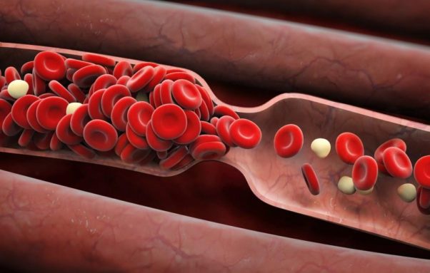 Blood clots block veins and cause swelling and pain. Sometimes they travel to the lungs and can cause death. (Photo: Shutterstock)