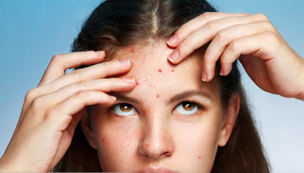 Do you know what type of pimple you have? (Photo: Shutterstock)