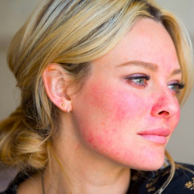 A blonde woman with rocea on her face. (Photo: Sarah Jagger)