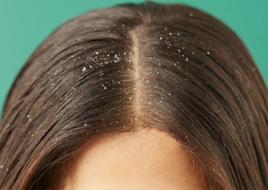A closeup of a woman's head with dandruff. (Photo: Tops Images)