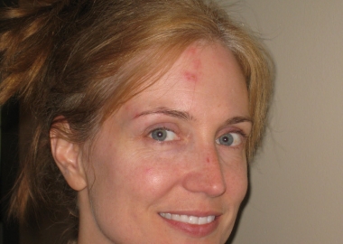 woman with shingles on the right side of her forehead and face. (Photo: Anna See)