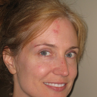 woman with shingles on the right side of her forehead and face. (Photo: Anna See)