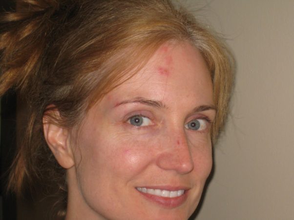 woman with shingles on the right side of her forehead and face. (Photo: Anna See)