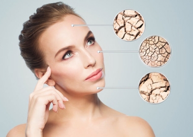 Head and shoulders shot of a woman with breakouts of dry skin on her forehead, cheek and chin. (Photo: Shutterstock)