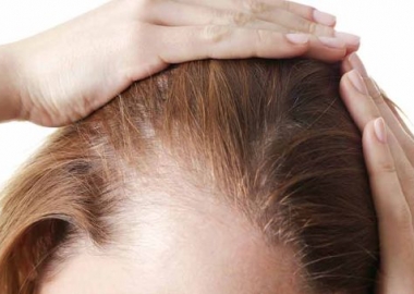 Woan's hairline showing thinning hair. (Photo: Shutterstock)