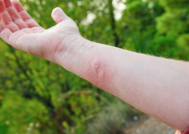 A mans arm with a bug bite on it. (Photo: Getty Images)