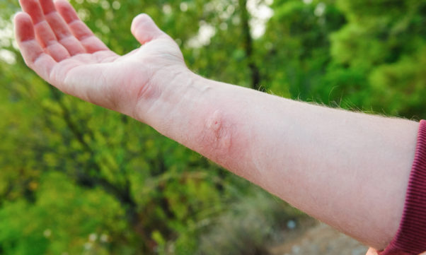 A mans arm with a bug bite on it. (Photo: Getty Images)