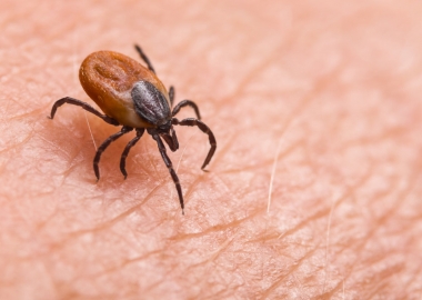 Deer tick on hairy skin. (Photo: Shutterstock)
