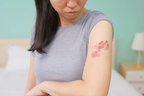 Woman with shingles on the skin she feels very painful. (Photo: Getty Images)